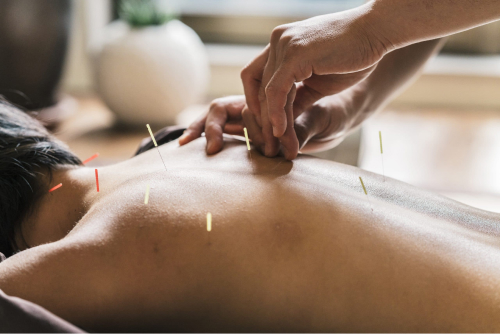 Иглоукалывание пациента